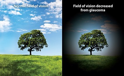 Glaucoma field loss